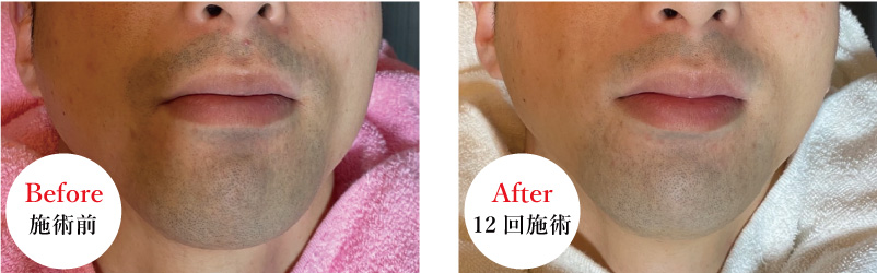 ■30代男性、鼻下・顎の施術