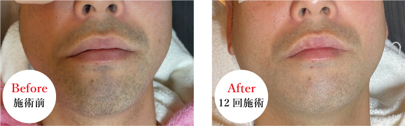 ■30代男性、鼻下・顎の施術